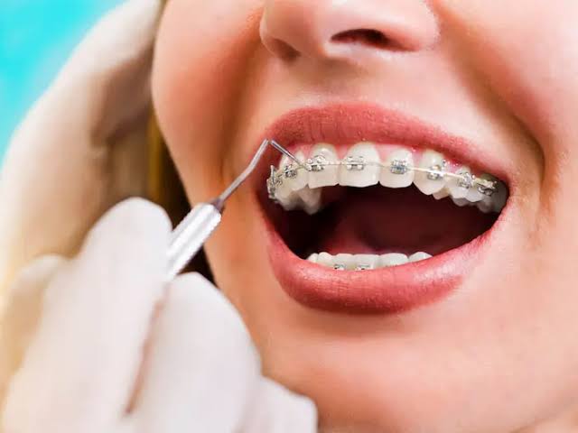 Close-up of a patient's dental braces