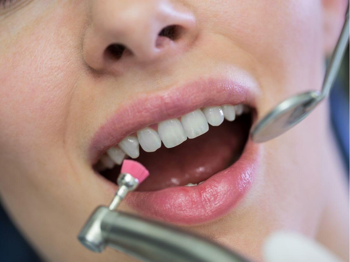 Dentist polishing a patient's teeth