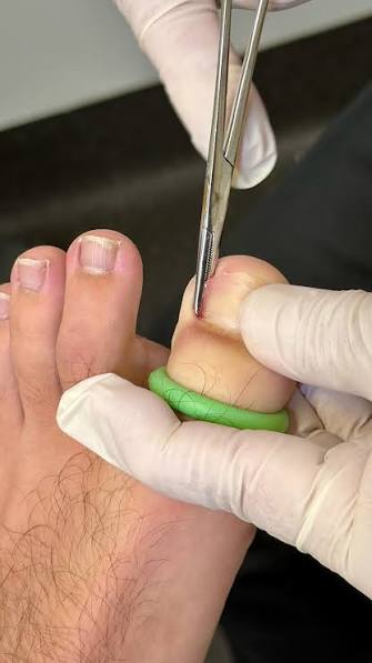 Nail avulsion at MM Care
