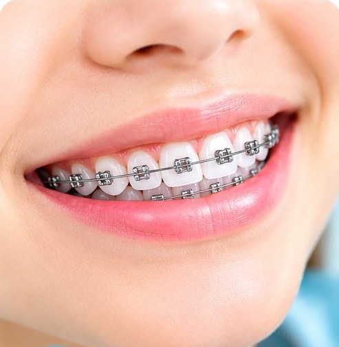 Conventional Braces at MM Care dental