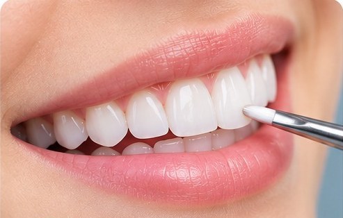 Direct Veneer at MM Care dental