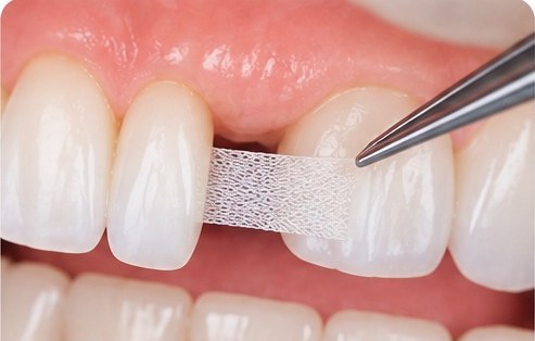 Fiber Reinforced Composite at MM Care dental