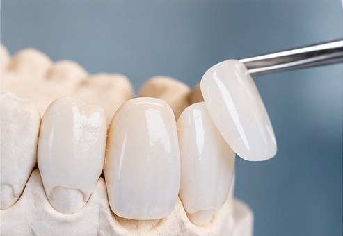 Indirect Veneer at MM Care dental