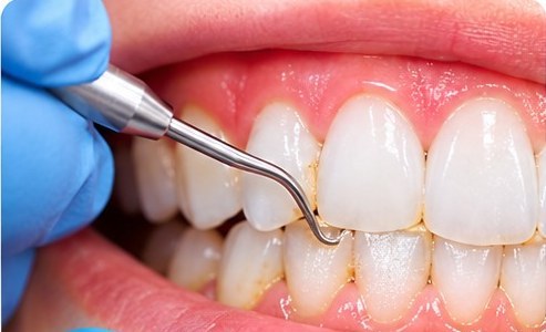Scaling & Polishing at MM Care dental