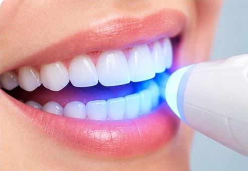 Whitening at MM Care dental